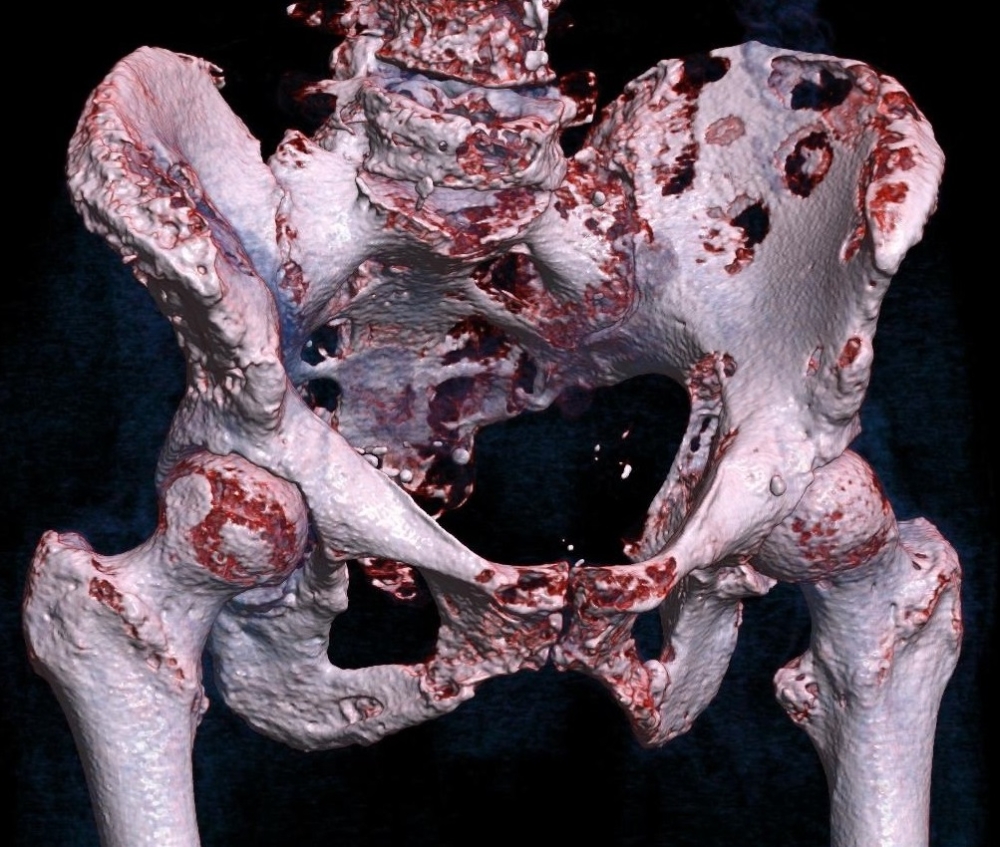 File:3D rendered CT of hip bone metastases.jpg