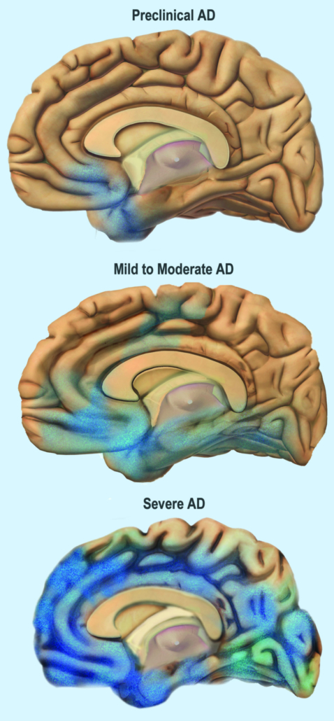 File:Alzheimer’s Disease, Spreads through the Brain (24524716351).jpg
