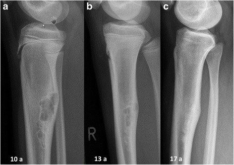 File:Fibroma non ossificante-RX.jpg